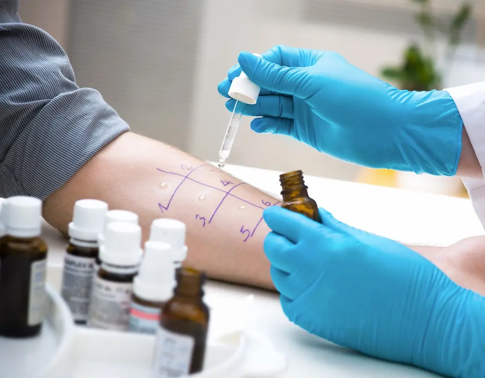 Ein Allergietest wird mittels verschiedener Flüssigkeiten an einem Unterarm durchgeführt