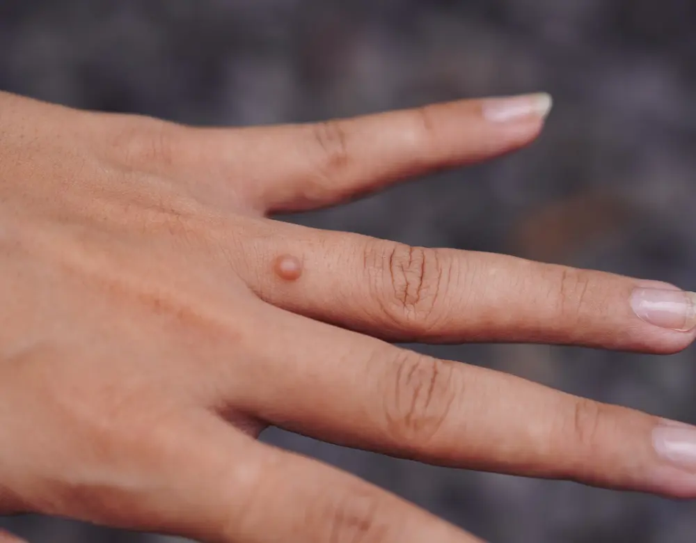 Nahaufnahme einer Hand; einer der Finger hat eine Warze