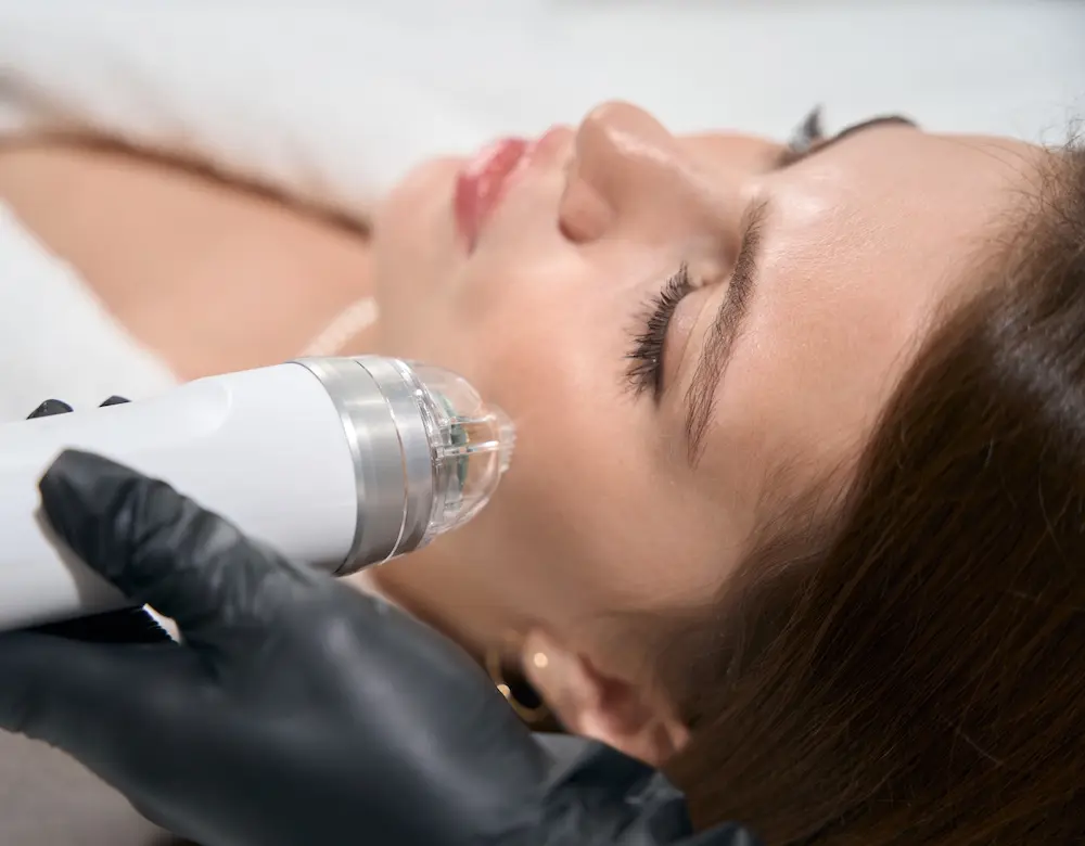 Hautzentrum Kurpark Radio Frequenz Eine Patientin lässt ihr Gesicht behandeln (Microneedling)